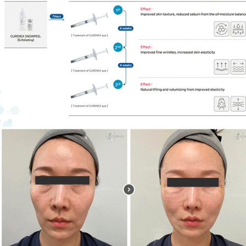 Curenex Eye PN Salmon DNA 1% advanced eye treatment syringe for reducing dark circles, puffiness, and fine lines with hydration and skin regeneration.