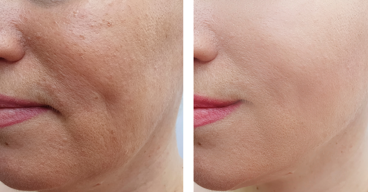 Before and after results of using Salmon DNA Serum Daily Skinbooster on facial skin, showing improved texture and radiance.